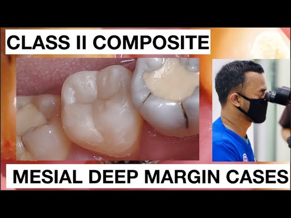 Step by step Class II Deep Margin Mesial Composite, General Dentist Griya