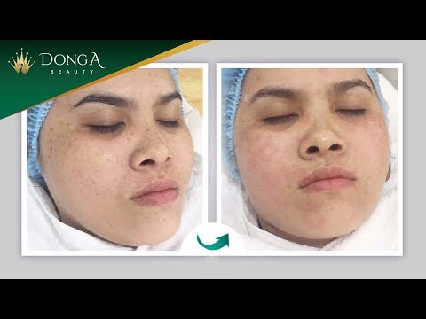 CẬ N CẢ NH Đ IỀ U TRỊ TÀ N NHANG TRÊ N MẶ T CHO KHÁ CH HÀ NG