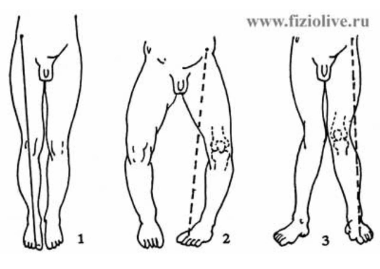 Варусная деформация оси нижних конечностей