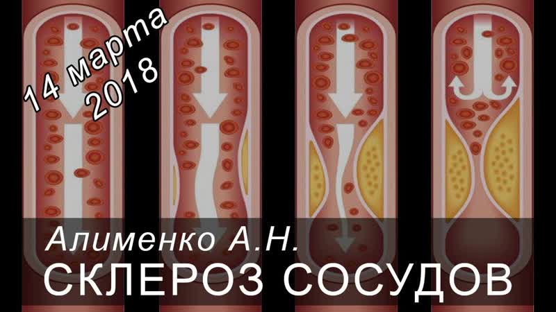 Склероз сосудов. Алименко А.